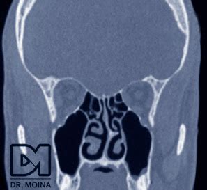 Rinoseptumplastia Tabique Nasal Desviado Desviacion Septal