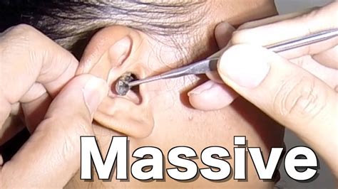 Hard Stone Like Earwax Clogged Woman S Ears Finally Removed Youtube