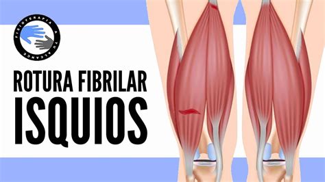 Rotura Fibrilar De Los Isquiotibiales Que Es Por Que Se Produce