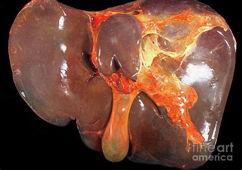 Human Liver And Gallbladder Photograph By Jose Calvo Science Photo