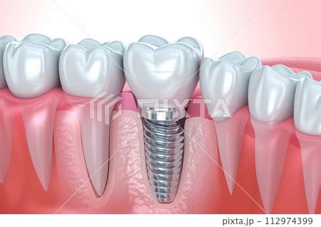 Tooth Implant Installed In Jaw Dental Surgery Pixta