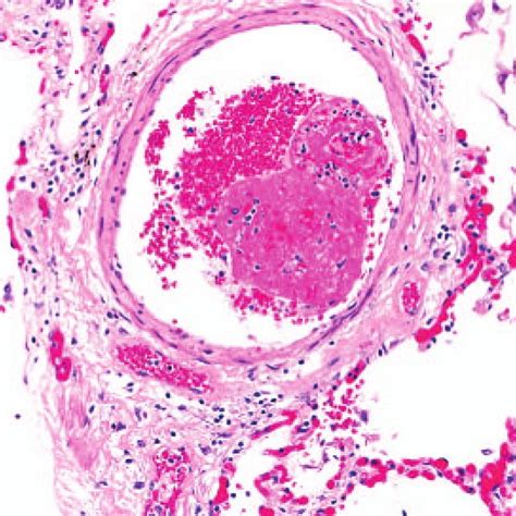 Histologic findings of lungs. Section of lung parenchyma demonstrates a ...