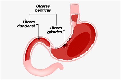 Como Identificar A Lcera No Duodeno E Como Tratar Tua Sa De