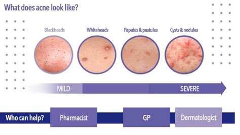 Mild To Moderate Acne What Does It Look Like And How To Treat It