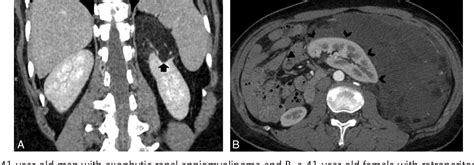 Figure 1 From Multidetector Computed Tomography Features In