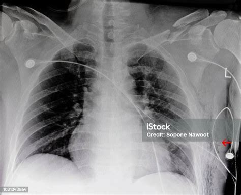 Chest Xray Film Of A Patient With Fracture Clavicle Stock Photo