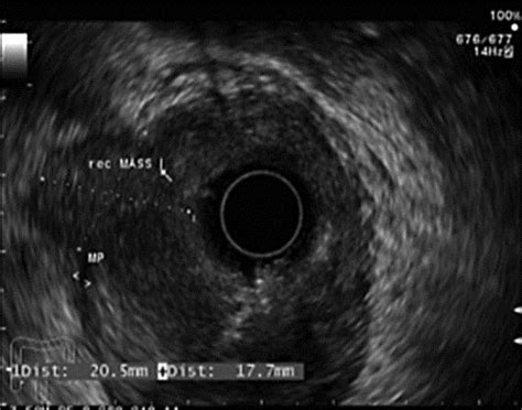 Hypoechoic Rectal Mass Extending Into The Muscularis Propria Download Scientific Diagram