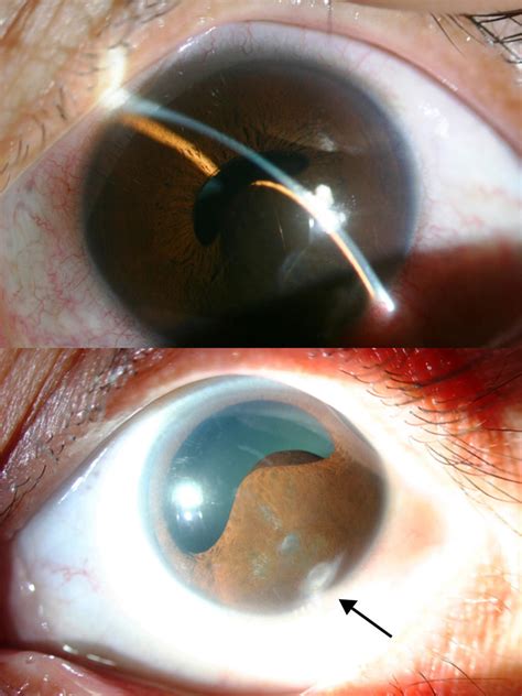 Biomicroscopy At Diagnostic Upper Image Large Inferior Temporal Iris