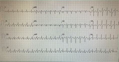 Visual Mnemonic For Causes Of Syncope What To Look For On An Ecg Rekg