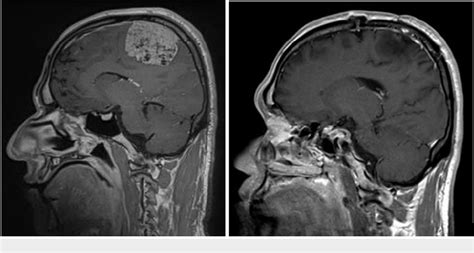 Figure 1 From Awake Craniotomy For Resection Of Intracranial Meningioma