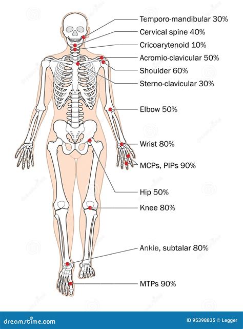 Sites Of Ra Stock Vector Illustration Of Sites Rheumatoid