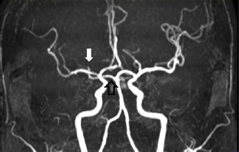 Mr Angiography Shows Stenosis Of Right Middle Arrow And Posterior