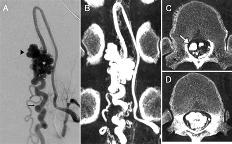 Preoperative Spinal Angiography And Cone Beam Computed Tomography CT