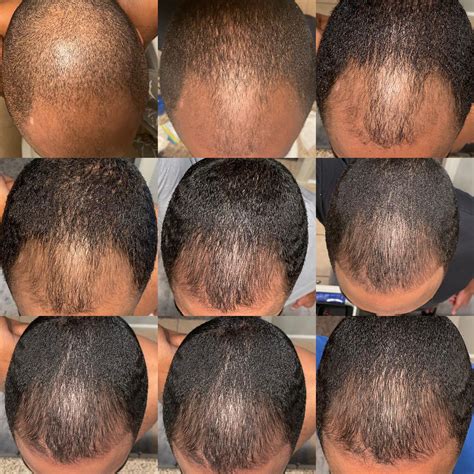 3 Month Finasterideminoxidil Results Rhairlossprogresspics