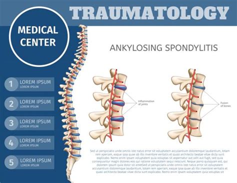 Spondylitis Is Stock Photos, Pictures & Royalty-Free Images - iStock