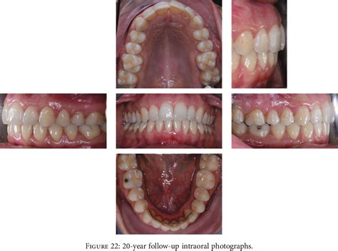 Figure 22 From Can Orthodontic Treatment Be Stable 20 Years After The