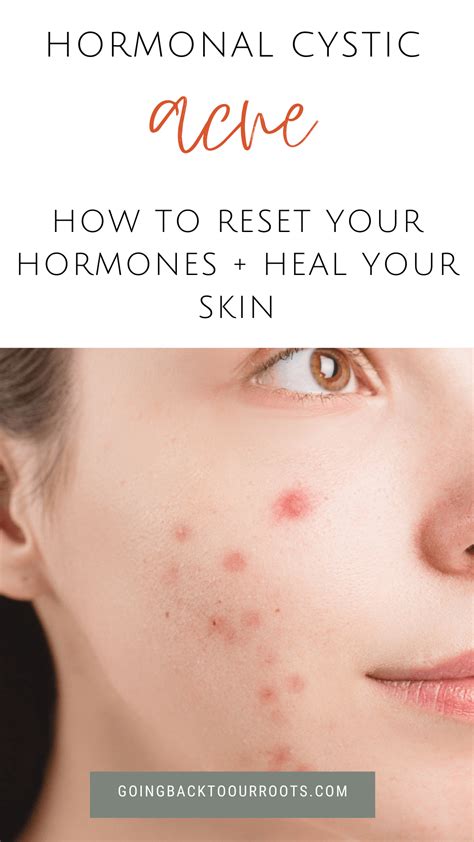 Hormonal Cystic Acne Causes Symptoms And Treatment