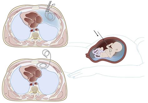 Non‐immune Hydrops Fetalis A Practical Guide For Obstetricians