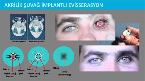 Dr.Nazım ŞUVAĞ Göz Kliniği-Hareketli Protez Göz Merkezi