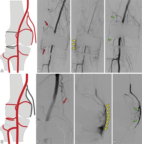 Geniculate Artery Embolization Role In Knee Hemarthrosis And