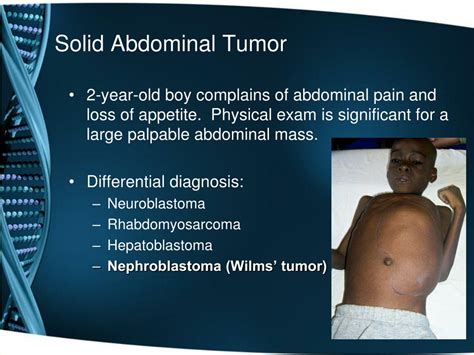 Ppt Pediatric Abdominal Tumors A Focus On Wilms’ Tumor Powerpoint Presentation Id 1259868