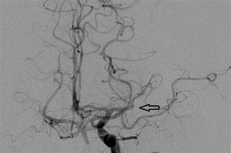 Endovascular Thrombectomy at MUSC | MUSC Health | Charleston SC