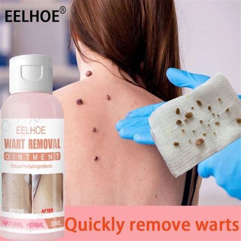 EELHOE Warts Remover Original Cream30mlRemover Flat Moles Warts Remover