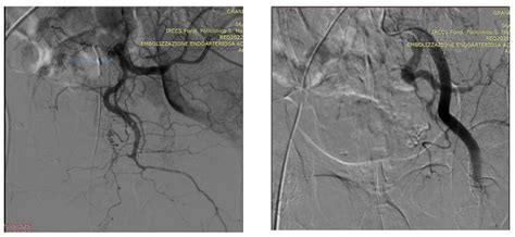 JCM Free Full Text Prostate Artery Embolization In The Treatment Of