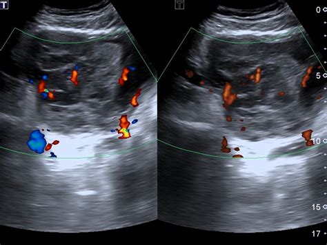 Prostate Cancer Ultrasound Image