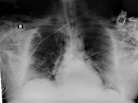 Ginko Leaf Sign And Subcutaneous Emphysema In A Patient With Covid 19