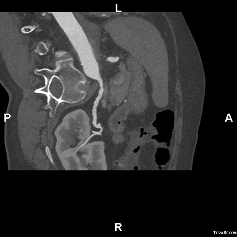 Fibromuscular Dysplasia Renal Arteries Image