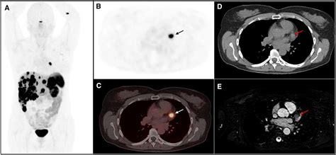 Ga Dotatoc Pet Ct In Myocardial Metastases Of Neuroendocrine