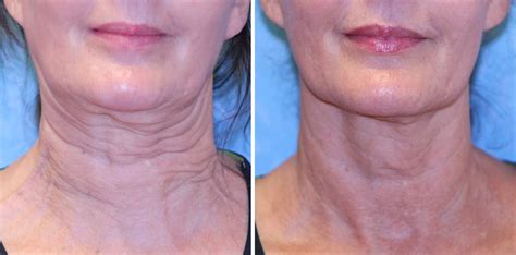 Newport Beach Sofwave Non Surgical Facial Lifting Dr John Laura