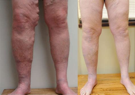 Vein Treatments Vein Specialists Of The Carolinas Treat Thousands Yearly