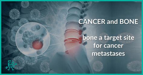 Cancer And Bone Biomedica