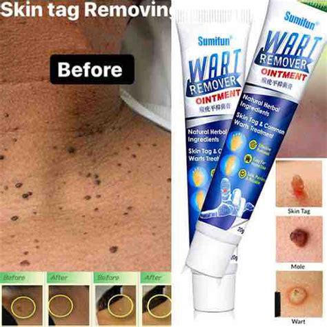 Wart Skin Tag Removal Allion Shop