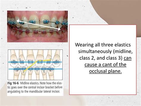 Intraoral Elastics In Orthodontics Pptx