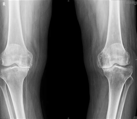 advanced OA Knee - Docjoints | Dr. Sujit Jos – Expert Shoulder, Knee