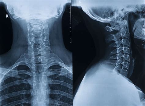 Cervical Vertebrae Anatomy Function Conditions