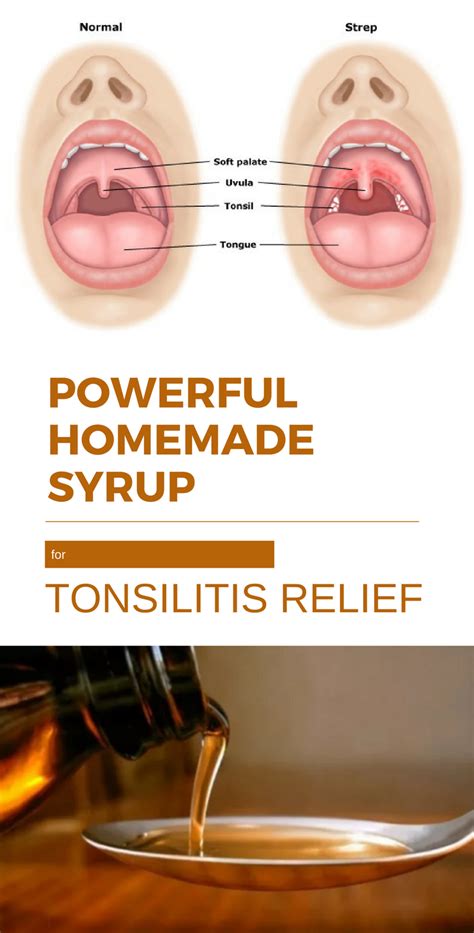 Powerful Homemade Syrup For Tonsillitis Relief #tonsilitis #syrup # ...