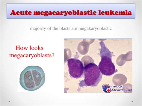 Acute Myeloid Leukemia Online Presentation