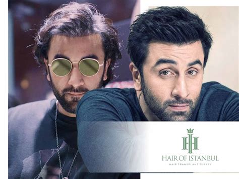 Ranbir Kapoor Before Hair Transplant