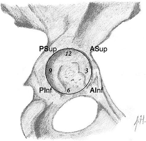 Acetabulum With Clockface Ainf Anteroinferior Asup Anterosuperior Download Scientific