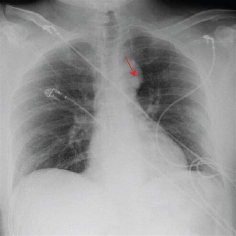 Chest X Ray A Anteroposterior View Showing A X Cm Nodular