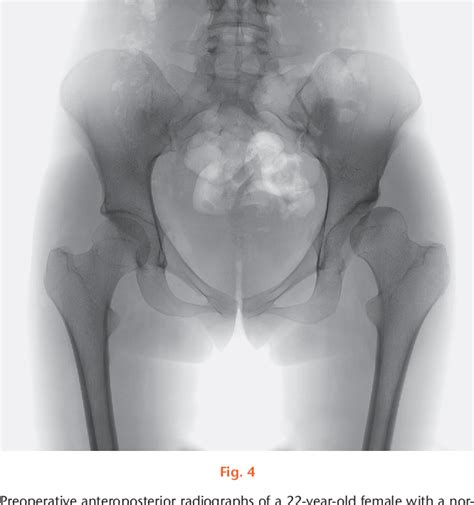 Figure From Ottawa Classification For Symptomatic Acetabular