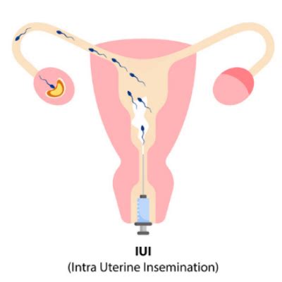 Everything You Need To Know About Iui Orkid Medilife Hospital