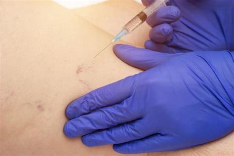 Successful Treatment of Spider Veins with Sclerotherapy: Center for ...