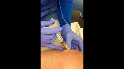 Prp Injection Treatment For Tennis Elbow Chronic Elbow Tendinitis