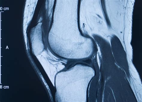 ACL Vs MCL Tears: What Is The Difference?