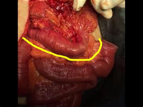 Diferencia Entre Intestino Delgado Y Grueso Comprender Los Procesos